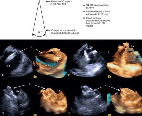 Intracardiac Echocardiography | Thoracic Key