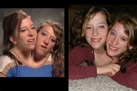 What Famous Conjoined Twins Abby And Brittany Hensel are Doing Today