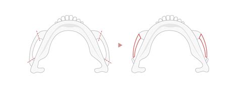 Lienjang Cheekbone Reduction - Lienjang Clinic Korea