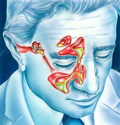 Sinus and ear infections, illustration - Stock Image - C037/9480 - Science Photo Library