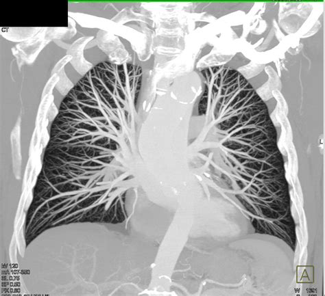 MIP of Normal Pulmonary Vasculature - Chest Case Studies - CTisus CT ...