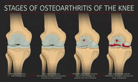 Osteoarthritis Knee Pain - Carolinas Pain Center - Charlotte - Huntersville