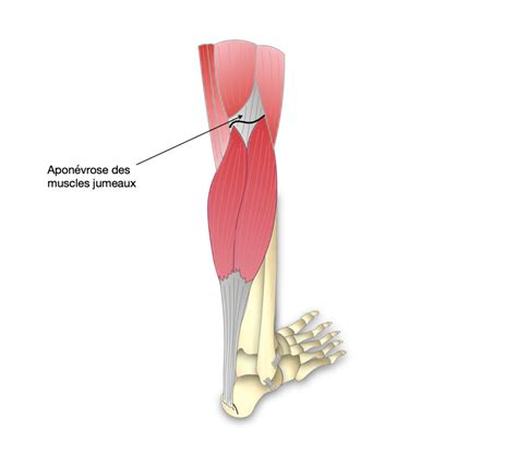 Aponévrosite plantaire - Dr Bovier-Lapierre