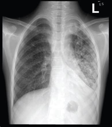 Tuberculosis, Active TB Chest X Ray, 56% OFF | wiener.me