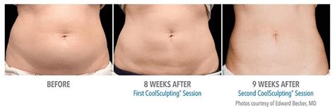 What is Coolsculpting? | What are the Benefits of Coolsculpting? | Glō