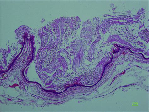 Histological slide of epidermoid cyst showing squamous epithelium ...