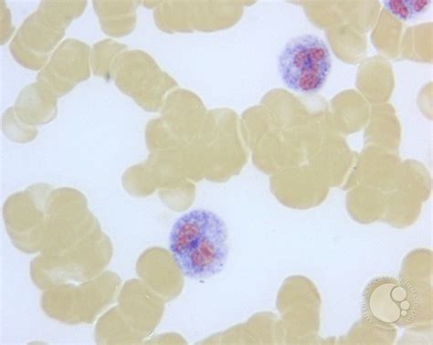 Leukocyte Alkaline Phosphatase Scoring - 3.