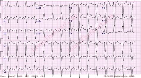 Left Atrial Enlargement ECG Example 2 | LearntheHeart.com