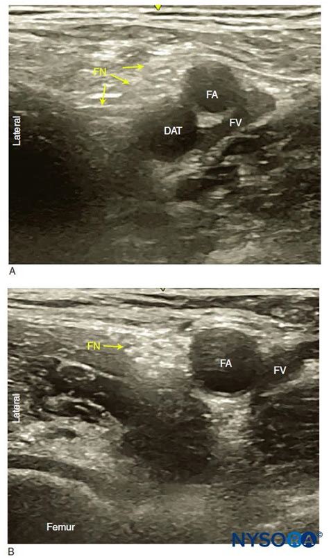 Ultrasound-Guided Femoral Nerve Block - NYSORA