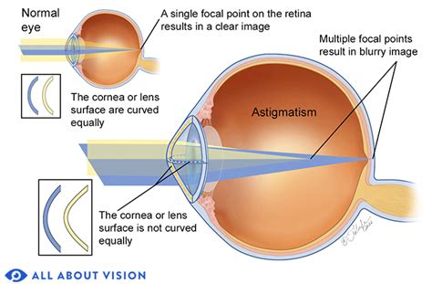 Astigmatism - Sheba Mayo