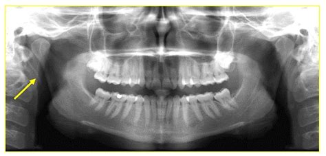 Cureus | Eagle’s Syndrome: A Case Report of a Unilateral Elongated Styloid Process