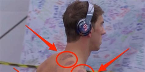 Olympian Michael Phelps has circle marks from cupping therapy: Benefits ...