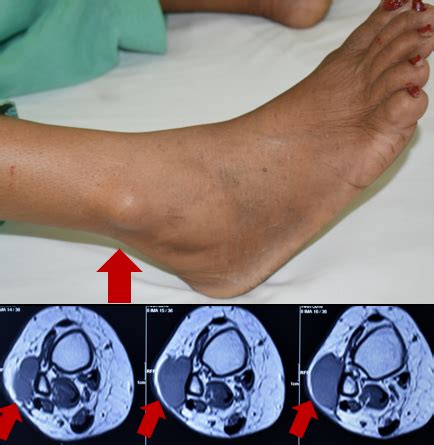 Soft Tissue Sarcoma Symptoms