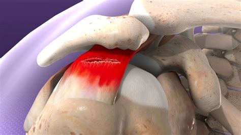 Shoulder Bone Spurs and Impingement Syndrome: Louis Peter Re, Jr., MD