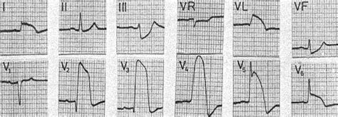 Coronary Artery Spasm | Circulation