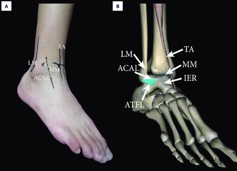 Preoperative examination of MRI showed anterior talofibular ligament... | Download Scientific ...