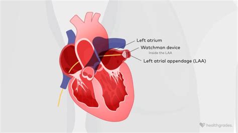 Watchman Procedure: Why It’s Done, Risks, and What to Expect