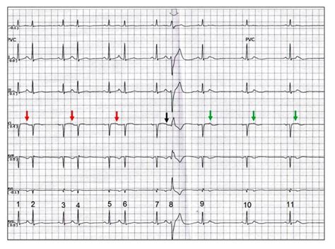 ECG Rhythms: Aberrancy