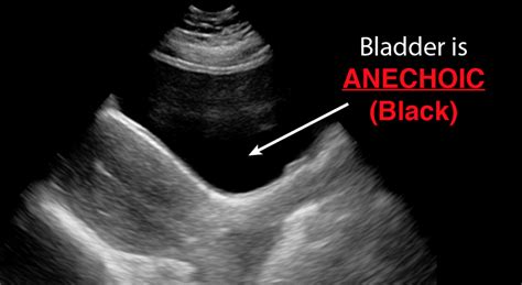 Basic Principles of Ultrasound Physics and Artifacts Made Easy - POCUS 101 (2022)