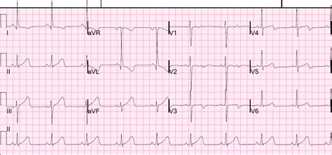 Dr. Smith's ECG Blog: Is this Acute Ischemia? More on LVH.