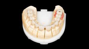 What Is a Zirconia Crown?