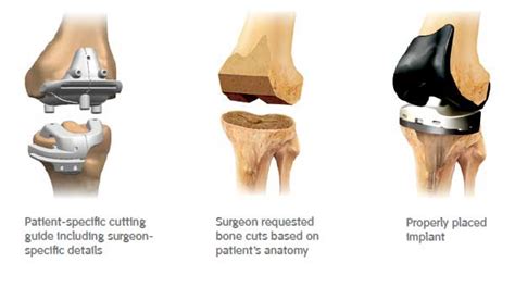 Patient Specific Knee Replacement