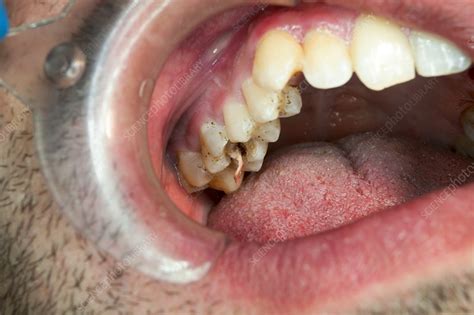 Root canal pulp extraction from molar - Stock Image - C038/7794 - Science Photo Library