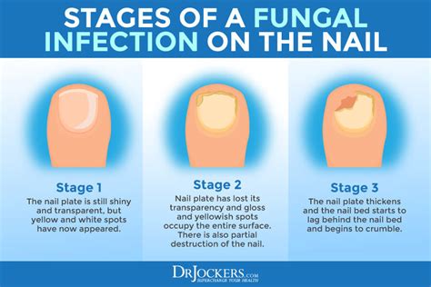 Toenail Fungus: Symptoms, Causes and Support Strategies