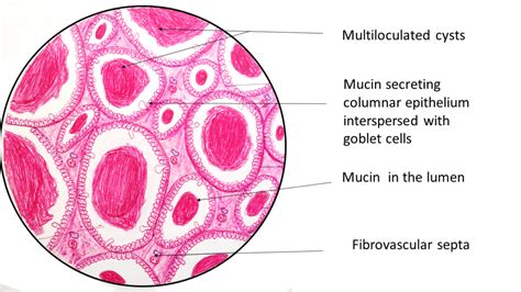 Mucinous Cystadenoma- Ovary - Pathology Made Simple