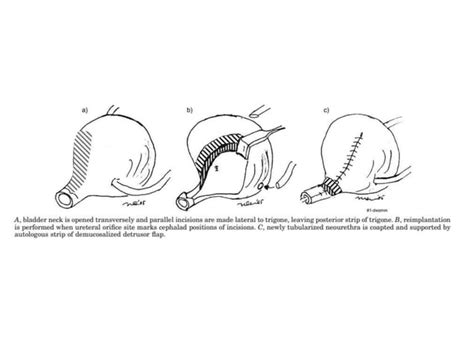 Bladder neck reconstruction