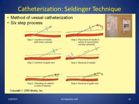 seldinger technique femoral artery - Google Search | Techniques, Catheter, Interventional radiology