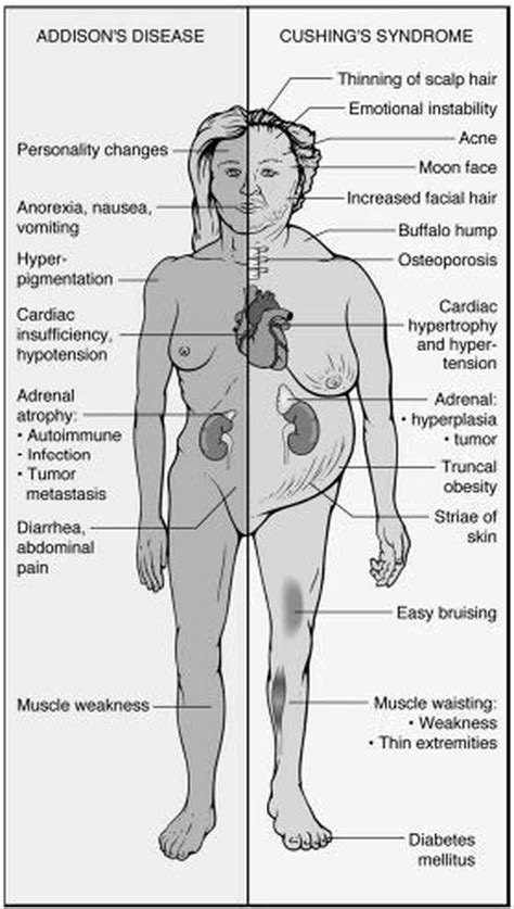 Addison's Disease Vs. Cushing's Syndrome - MEDizzy