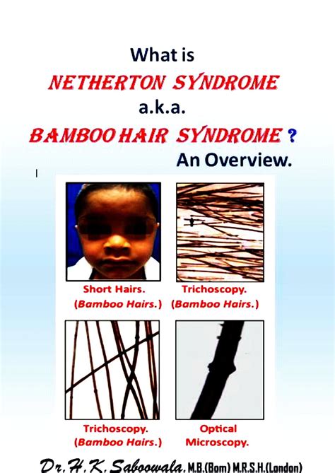 What is Netherton Syndrome a.k.a. Bamboo Hair Syndrome ? An Overview ...