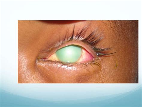 Chemical injuries of the eye