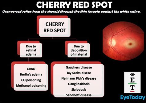 Cherry Red Spot - EyeToday