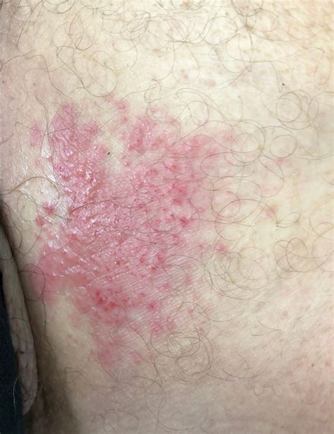 Cutaneous Candidiasis - Nancy Morgan | Nancy Morgan