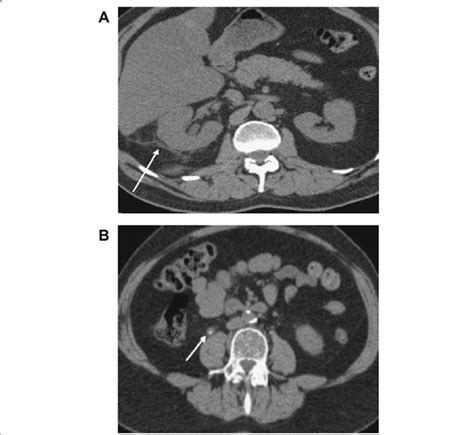 Features of perinephric fat stranding (a), and tissue rim sign (b)... | Download Scientific Diagram