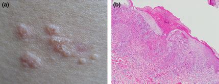 Close view of umbilicated papules with scale on the upper back in a ...