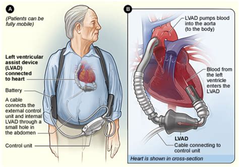 LVAD Management In The ED — NUEM Blog