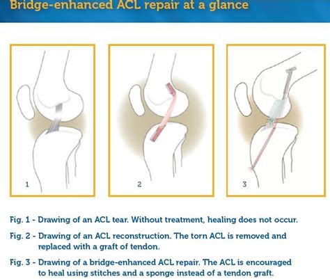 ACL regrowth BEAR trials (bridge assisted ACL Repair) — Ryan Cartier