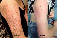 17 PicoSure Before & After ideas | laser tattoo removal, tattoo removal ...