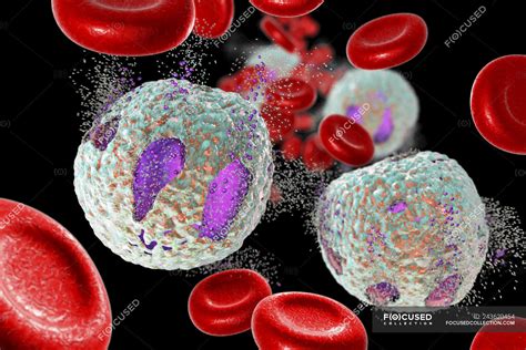 Digital illustration showing destruction of lymphoblast cells, acute lymphoblastic leukaemia ...