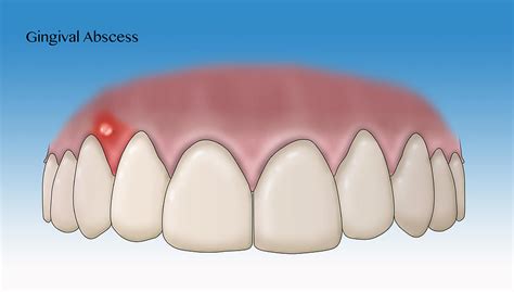 Gingival Abscess, Illustration Photograph by Monica Schroeder - Fine ...