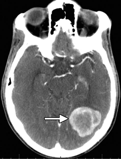 Imaging Features of Solitary Fibrous Tumors | AJR