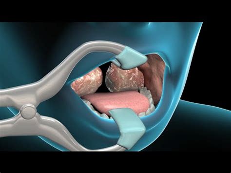 Tonsillectomy & Adenoidectomy | Nucleus Health - YouTube