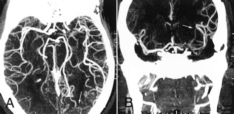 Collateral Circulation | Stroke