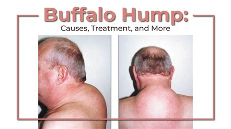 Buffalo Hump: Causes, Treatment, and More