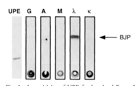 Figure 5 from Urine protein electrophoresis and immunofixation ...