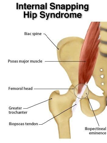 Snapping Hip | Internal and External Snapping Hip Syndrome Treatment in Boulder, CO | Austin Chen MD