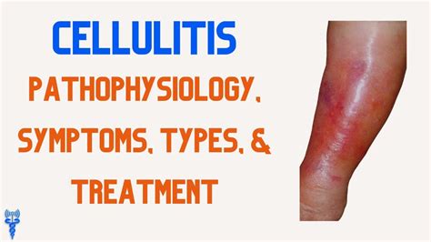 Cellulitis Symptoms Causes Pictures And Treatment